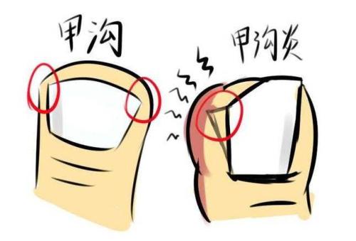 甲沟炎图片是什么样的