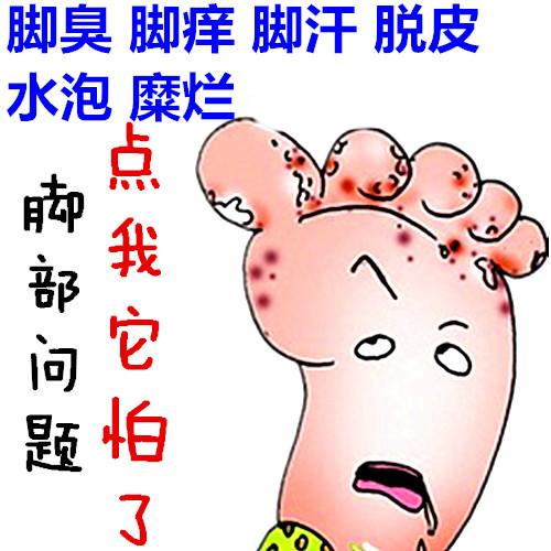 手足癣的常见类型有哪些