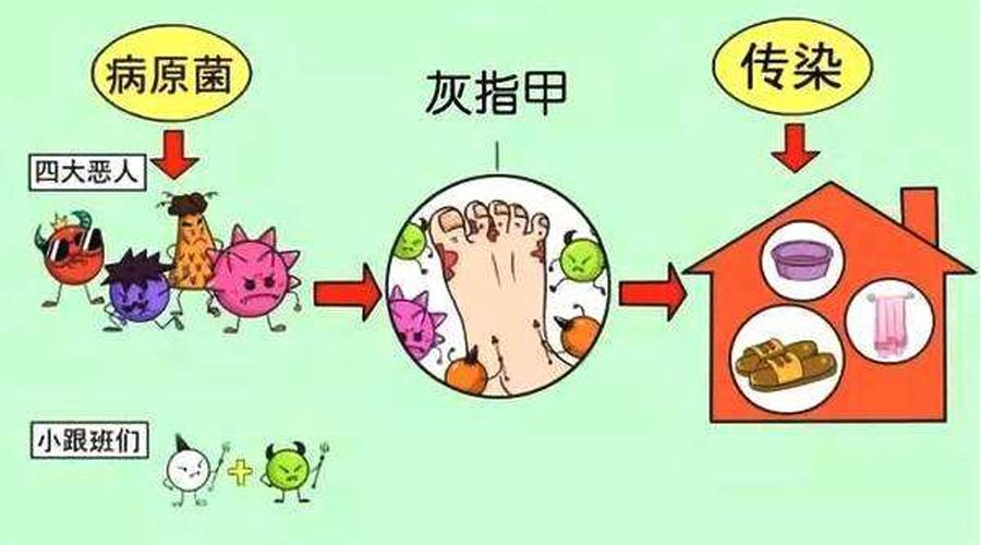 近端甲下型灰指甲有什么症状